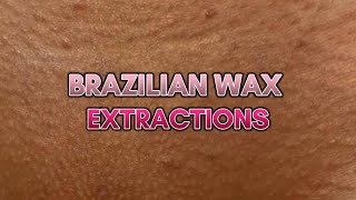 Maximizing Comfort How to Extract Ingrown Hair After a Brazilian Wax [upl. by Akcebar]