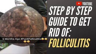 Step by step guide to get rid of folliculitis [upl. by Llorre754]