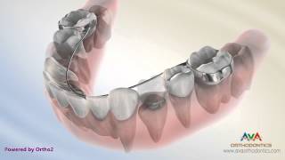 Orthodontic Space Management  Lingual Arch Appliance [upl. by Salsbury]