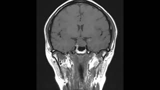 Pituitary macroademoma that compresses the optic chiasm [upl. by Isabelita473]