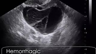 case 609 Hemorrhagic corpus luteum cyst CLC [upl. by Yahc]