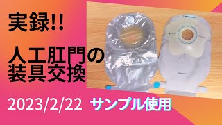 【実録】サンプル使用 コロプラスト センシュラミオコンケープ：人工肛門ストーマの装具交換 2023222 プロケア―ソフトウエハー･リング [upl. by Seleta]