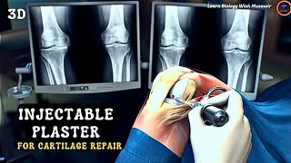 Injectable Plasters For Cartilage Repair  Animated Video [upl. by Alfy26]