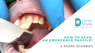 How to scan an emergence profile 3 Shape scanner [upl. by Notnil186]