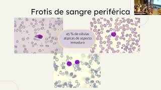 Leucemia de células dendríticas plasmocitoides a propósito de un caso [upl. by Steinberg750]