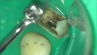 Повторное лечение корневых каналов Root canal retreatment [upl. by Atiuqa]