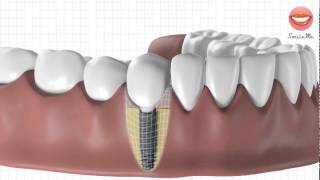 Vidéo de démonstration pour une pose dimplant dentaire [upl. by Anelac503]