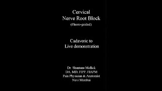 Cervical Transforaminal Nerve Root Block [upl. by Pliner303]