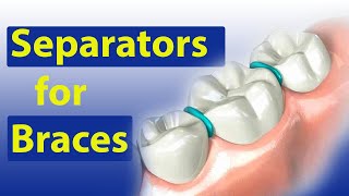 Separators Spacers for Braces  Braces Guide [upl. by Andromeda237]