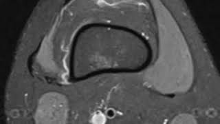 Fibroma or focal synovitis in knee [upl. by Hannaj737]