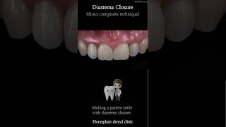 정즁 치간 이개 벌어진 앞니 레진 치료정중치간이개 벌어진앞니 블랙트라이앵글 diastema blacktriangle [upl. by Laurel]