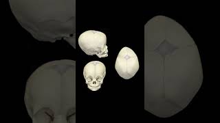 Congenital skull abnormalities craniosynostosis skull skulldeformity flathead fauquierent [upl. by Cho611]