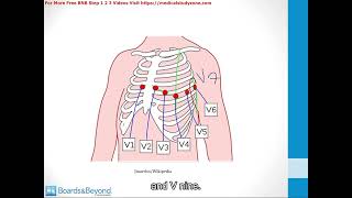 075  Cardiac Ischemia  STEMImp4 [upl. by Olegna249]