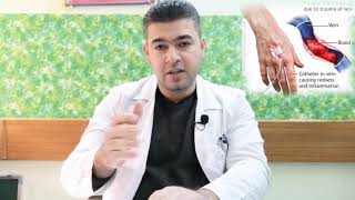 Thrombophlebitis التهاب الوريد الخثري [upl. by Brindell]