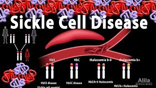 Sickle Cell Disease Animation [upl. by Genisia]