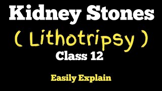 What Is Kidney Stone And What Causes It  Lithotripsy  Class 12 Biology [upl. by Nereil]