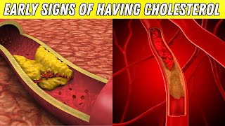 STOP Ignoring These 5 Early Cholesterol Disease Warning Signs [upl. by Nalrah218]