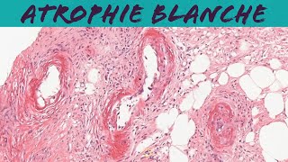 Atrophie blanche livedoid vasculopathy dermatology dermpath pathology [upl. by Eissirc]