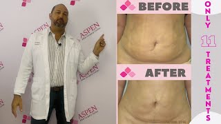 Liposuction Fibrosis Treatment Soften and Smooth Lumps and Bumps [upl. by Bonneau]