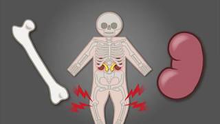 Treating XLinked Hypophosphatemia in Children [upl. by Sew]