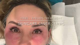 TIXEL EYELIDS TREATMENT  SKINCARE LASER CLINIC POINTCOOK MELBOURNE [upl. by Forrer]