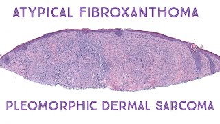 Atypical Fibroxanthoma amp Pleomorphic Dermal Sarcoma Oregon case 2 [upl. by Parhe]