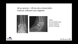 Principles of nonunion management  3 of 3 [upl. by Kathryn]