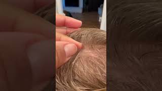 Lice picking l lice removal l small business explore hair lice hairvideo [upl. by Ahsinoj717]