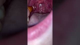 Tonsil stones 62 [upl. by Russon186]