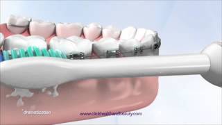 How to use your Philips Sonicare Toothbrush perfect for braces too [upl. by Xila283]