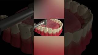 Tooth Cavity Filling Procedure tooth health shorts [upl. by Jaquelyn991]