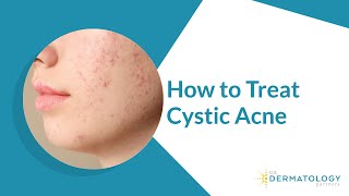 How to Treat Cystic Acne [upl. by Ahsieyt]