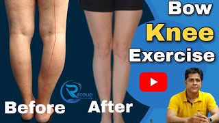 bow knee correction exercisebow knee problem solutionbow knee kaise thik kare in hindibowknee [upl. by Lashondra]