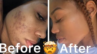 Skin Care Journey How I cleared my skin Do’s and DONT’s Epiduo Forte review [upl. by Eelahs]