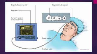 Bispectral index in hypercapnic encephalopathy  Video abstract ID 167020 [upl. by Prestige]