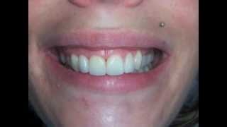 Sourire gingival et facettes dentaires [upl. by Kavanaugh]