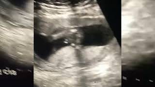 posterior placenta and Baby boy DrRimshaBaby boy om ultrasound [upl. by Opalina580]