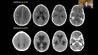 Approach to Pediatric Neuroimaging by Dr Kish Part II [upl. by Eetsim]