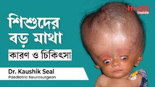 শিশুদের অতিরিক্ত বড় মাথা বা হাইড্রোসেফালাস কি কারণ ও চিকিৎসা  Hydrocephalus Baby Treatment [upl. by Llednav]