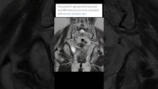 Serous inclusion cyst of ovary mri radiologysonology youtubeshorts shortvideo ctisus [upl. by Akehs745]