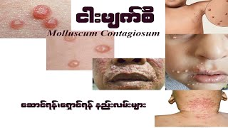 ငါးမျက်စိ Molluscum Contagiosum [upl. by Nivlam]