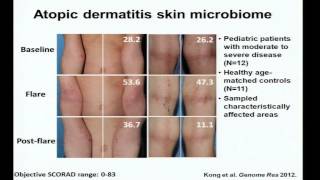 Eczema Immunity and the Skin Microbiome  Heidi Kong [upl. by Luhem]