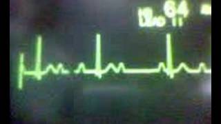 ECG Video AV Block  Second Degree Type 1 Wenckebach [upl. by Tobey524]