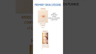 SKIN LESIONS Papule Vs Nodule [upl. by Noryk251]