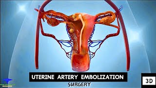 Uterine Artery Embolization  Tumor Cell Removing Surgery [upl. by Colville767]