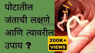 पोटातील जंत लक्षणे त्यावरील उपाय  जंत झालेत कसे ओळखावे Worms  janta check description [upl. by Grane]