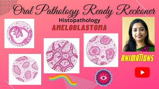 Ameloblastoma Odontogenic TumorsI Follicular PlexiformAcanthomatous Granular [upl. by Maise]