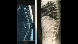 How Spinal Fusion Went For Me [upl. by Marie]