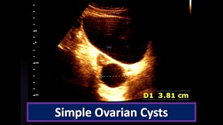 Understanding Simple Ovarian Cysts Ultrasound Findings  Ovarian Cyst  Simple follicular cyst [upl. by Nileuqay]