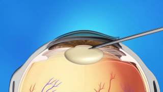 Cataract Surgery Animation [upl. by Zinn]